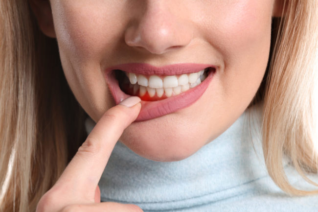 Woman,With,Gum,Inflammation,,Closeup Restore gums with pinhole gum surgery in San Francisco