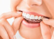 Invisalign Clear Braces at San Francisco Green Dentistry