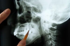 A dentist pointing to a jawbone with a pencil.