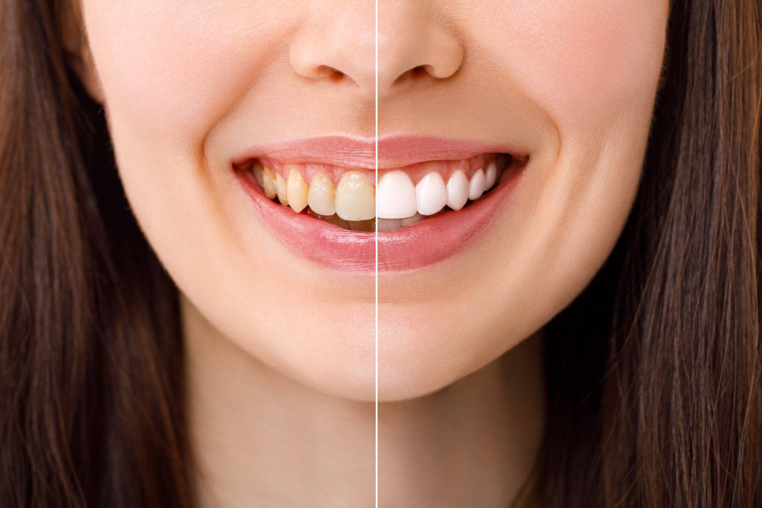 before and after professional teeth whitening treatment