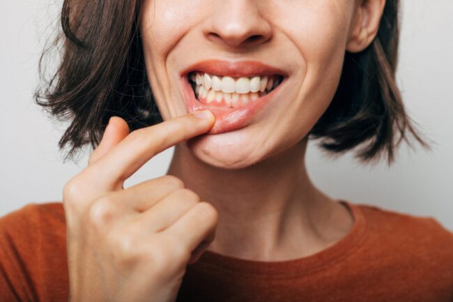 Close,Up,Shot,Of,Gum,Inflammation.,Cropped,Shot,Of,A Close up shot of gum inflammation. Cropped shot of a young woman showing red bleeding gums isolated on a gray background.