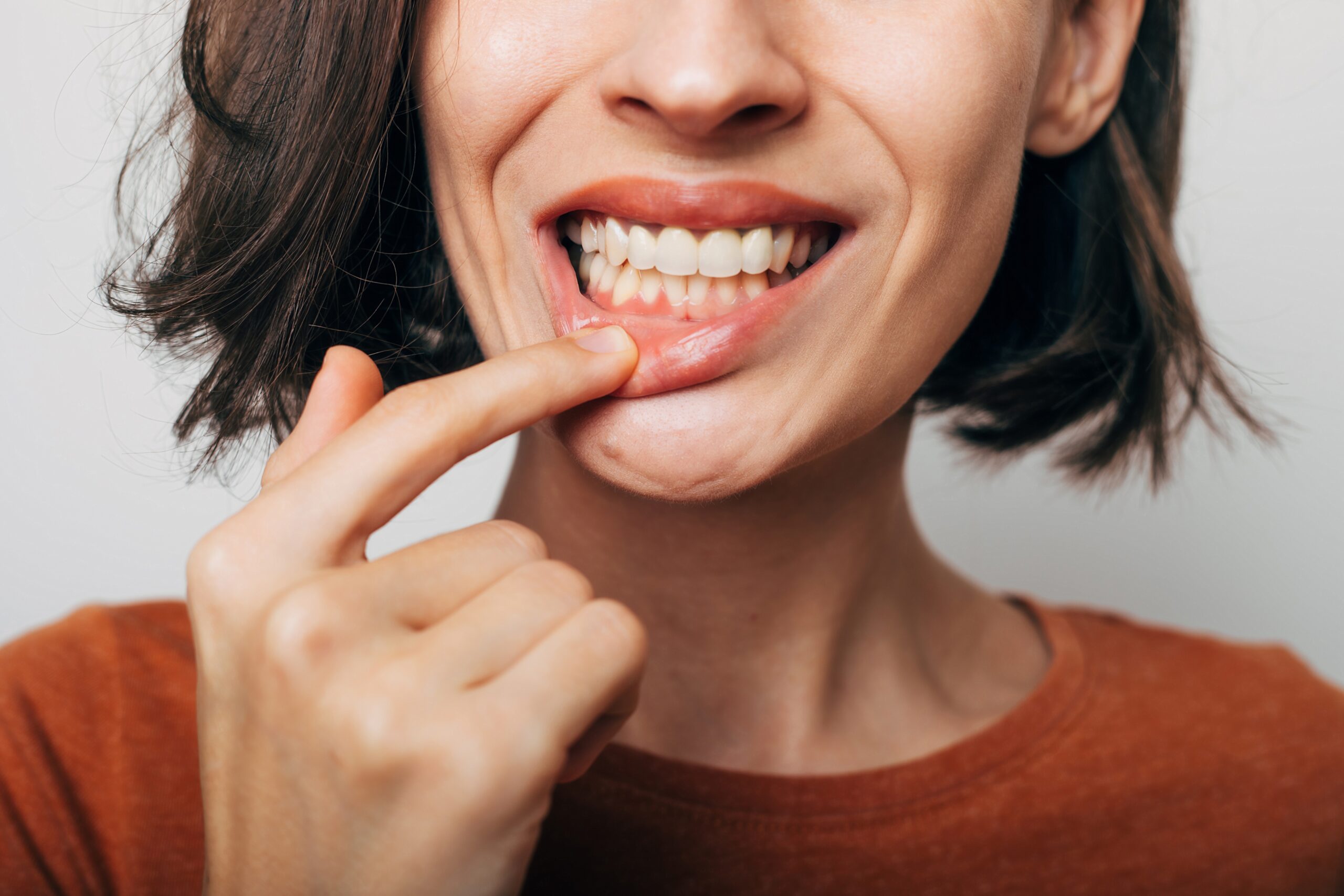 Close,Up,Shot,Of,Gum,Inflammation.,Cropped,Shot,Of,A Close up shot of gum inflammation. Cropped shot of a young woman showing red bleeding gums isolated on a gray background.